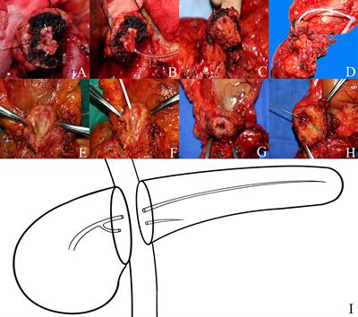 Incidence of bifid pancreatic duct in pancreaticoduodenectomy and its impact on clinically relevant postoperative pancreatic fistula